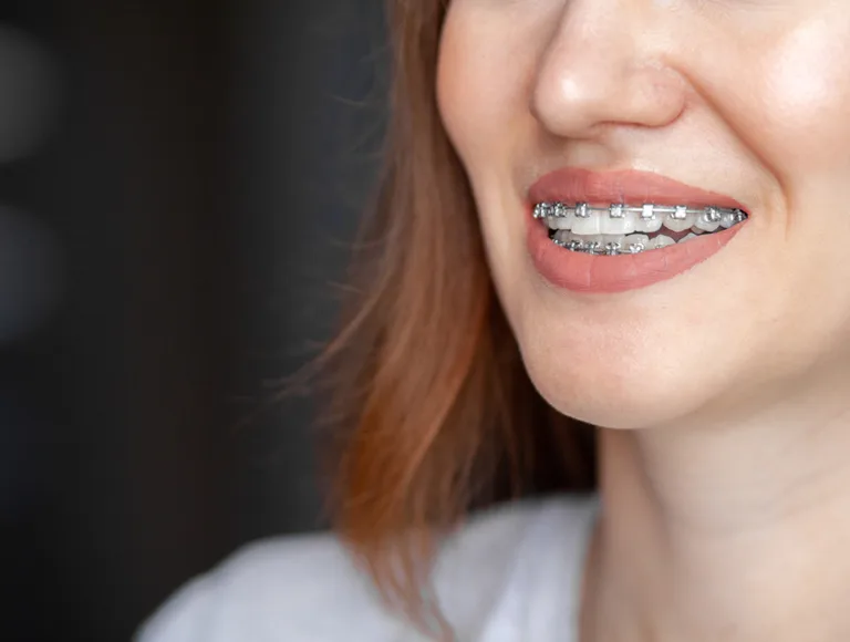 Traditional Metal Braces