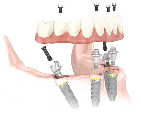 All-on-4 dental implants Bakersfield