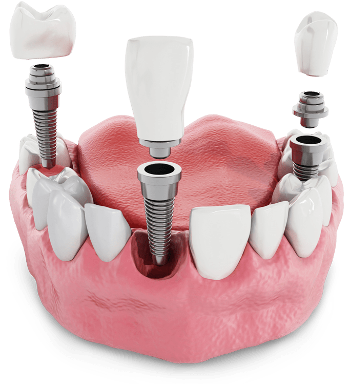 Dental implant